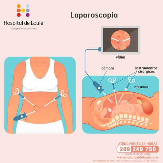 What is a laparoscopy?